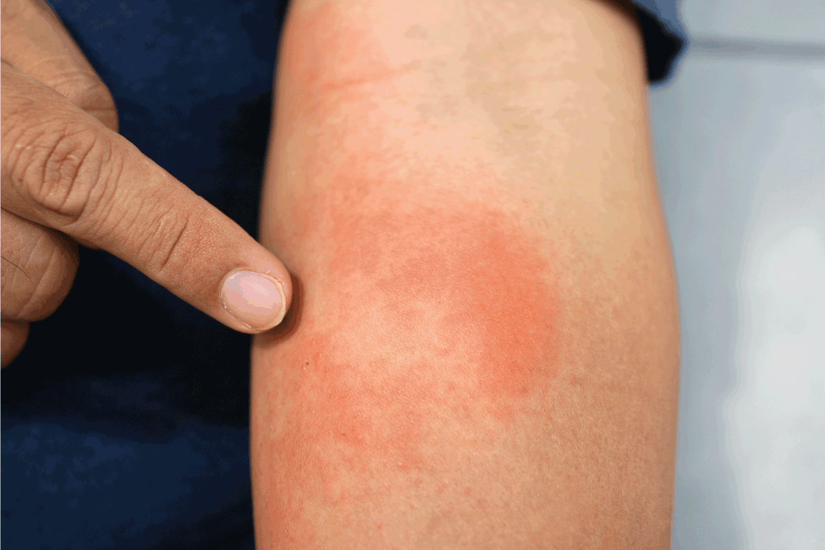 A close-up of bad psoriasis on a person's forearm