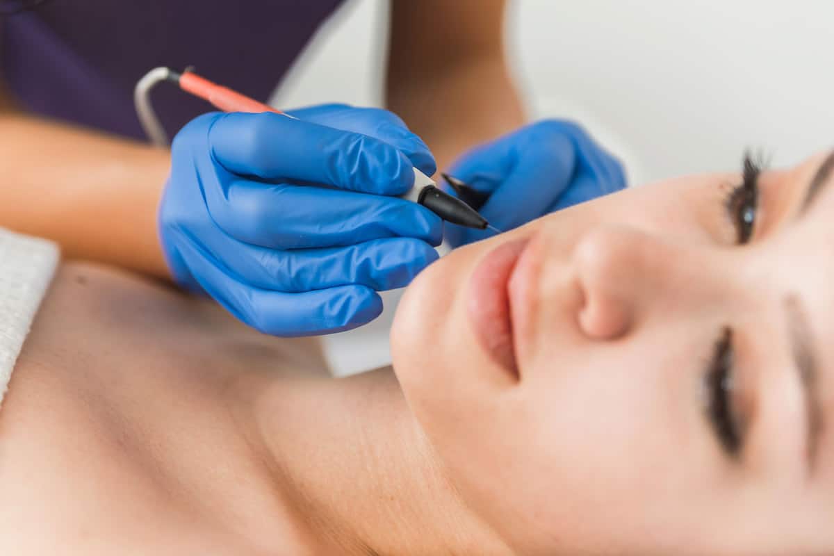 Dermatologist doing hair removal treatment on patients face with electrolysis