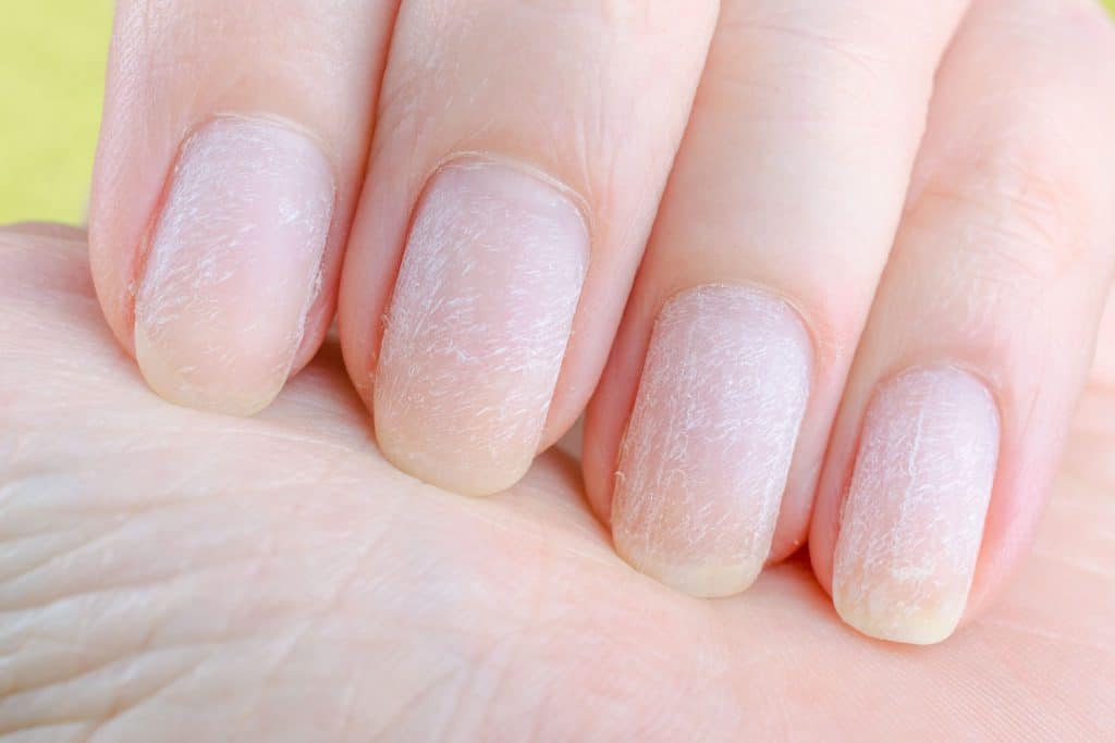 Damaged nails due to the unethical practice of removing nail polish