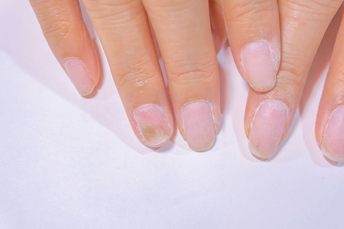 Fingernails infected from green fungi