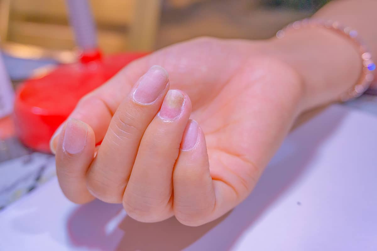 Woamn fingernails infected from green fungi cause of unhealthy human body nail grow