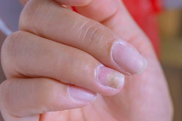 Woman's fingernails infected by mold, Scary Discovery: Woman Finds Mold Growing Under Acrylic Nails